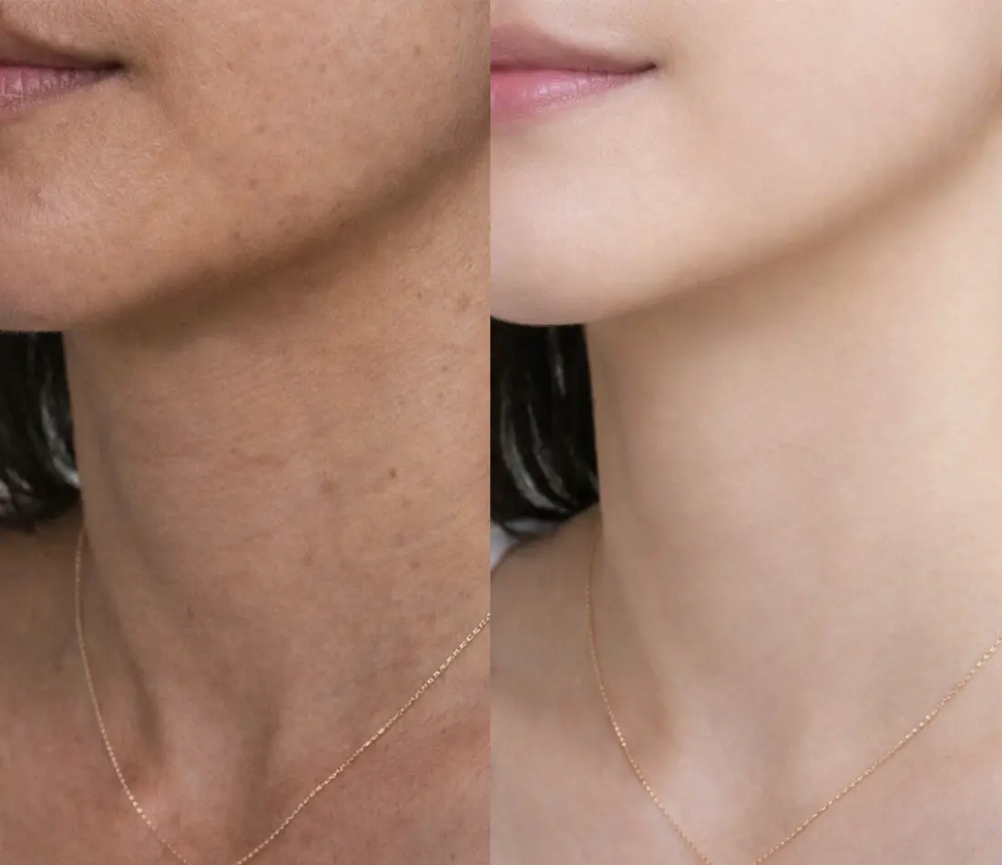 A split-screen image showing a woman's neck and chin area, with the left side having a more tanned complexion and visible freckles, and the right side appearing smoother and paler, with both sides wearing a thin gold necklace